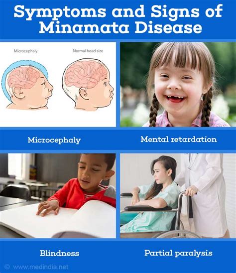 minamata disease symptoms